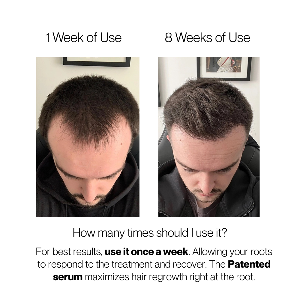Cellular Hairline Renewal System + DHT Blocking Peptide Serum - 2 Month Supply - 1 Free Month Included.