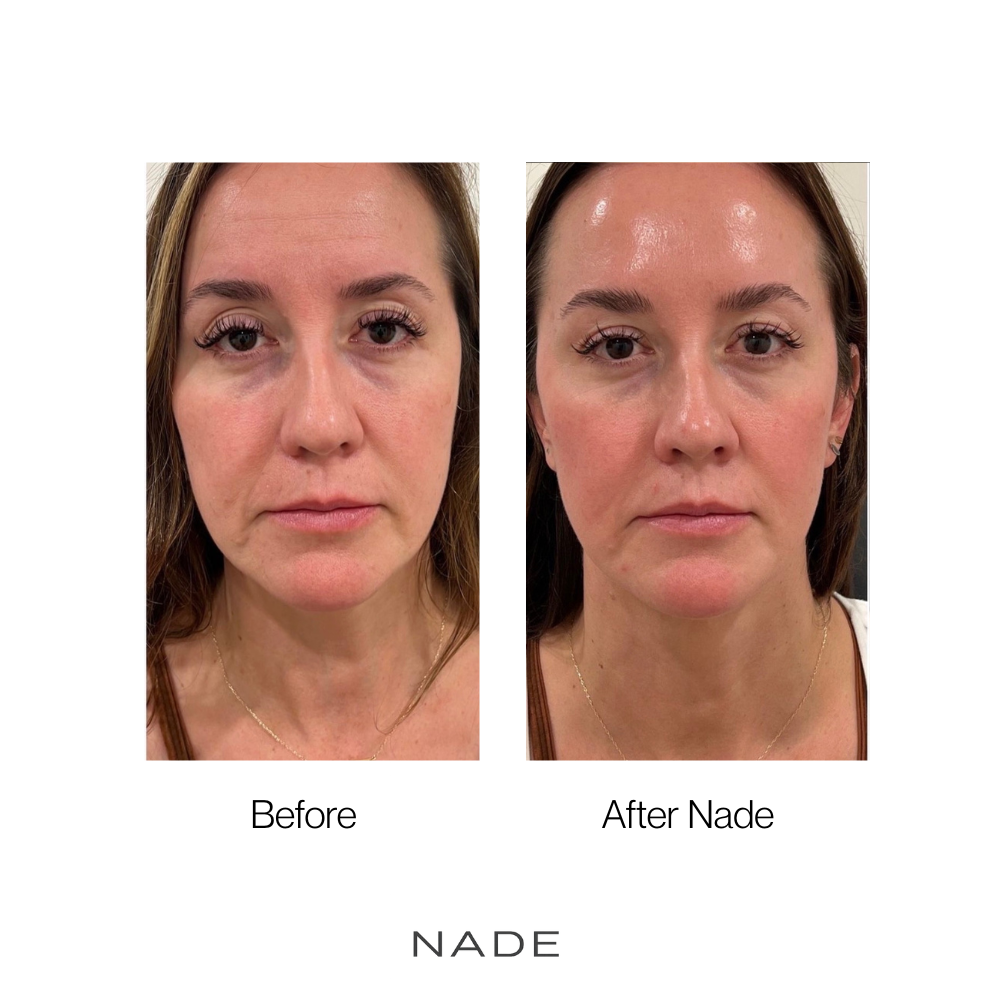 NADE Micro Infusion System + NAD+ & Copper Peptide Serum
